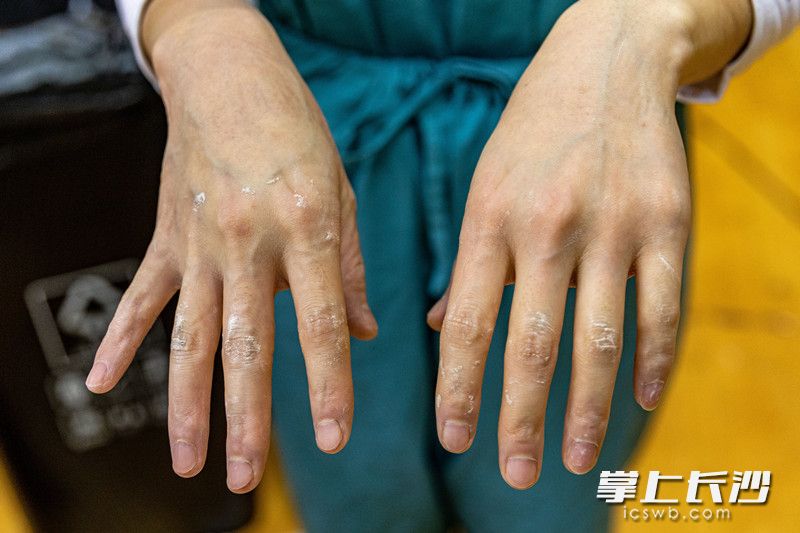 陶荣脱下手套后，手套中的滑石粉已凝固成一团团粘在她的手指关节上。